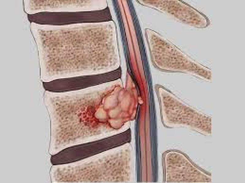 مشمولان مبتلا به تومور استخوانی ستون فقرات از سربازی معاف می شوند