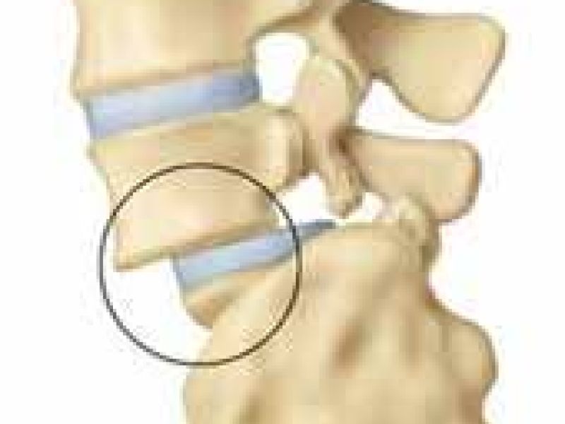 شرایط معافیت پزشکی مشمولان  مبتلایان به اسپوند يلوليزيس واسپونديلوليستزيس و رتروليستزيس