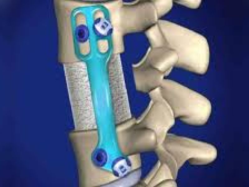 مشمولانی که عمل لامینکتومی انجام دهند از سربازی معاف می شوند